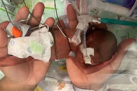 Chào đời chỉ 21 tuần tuổi, cậu bé phá kỷ lục sinh non nhất thế giới