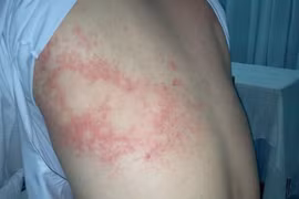 Mày đay mạn tính do ăn đồ sống