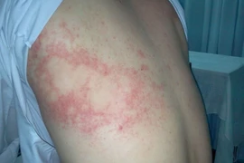 Mày đay mạn tính do ăn đồ sống