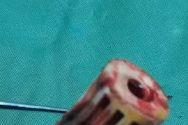 Lấy lô cuốn tóc trong vùng kín cho cụ bà 81 tuổi