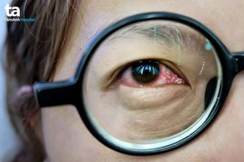 Viêm màng bồ đào có thể ảnh hưởng toàn cơ thể