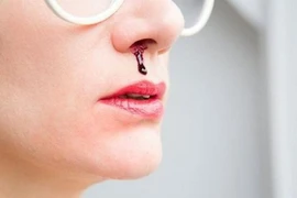 Xử lý chảy máu mũi đúng để tránh nguy hiểm