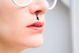 Xử lý chảy máu mũi đúng để tránh nguy hiểm