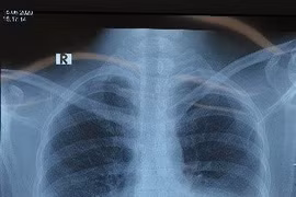 Tràn dịch dưỡng chấp sau vét hạch cổ 