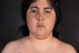 Mắc cushing vì dùng thuốc không rõ nguồn gốc