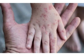 Đeo khẩu trang phòng chống đậu mùa khỉ ? 