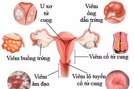 Vợ viêm âm đạo sau mỗi lần quan hệ