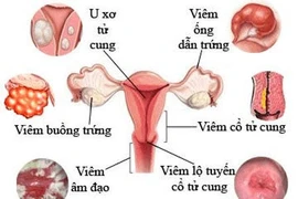 Vợ viêm âm đạo sau mỗi lần quan hệ