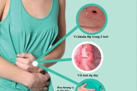  Phát hiện các bệnh lý dễ phát sinh ung thư dạ dày