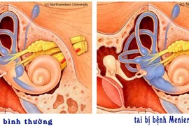 Tai ù do sũng nước mê nhĩ