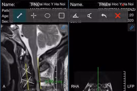 Liệt vì tự đi chữa bệnh cột sống