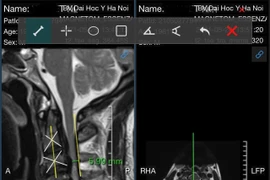 Liệt vì tự đi chữa bệnh cột sống