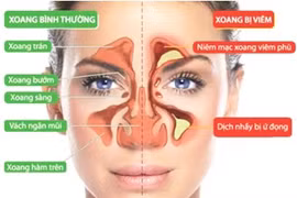 Biện pháp tổng thể điều trị viêm xoang mũi