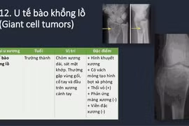 Đau vai do u xương tế bào khổng lồ