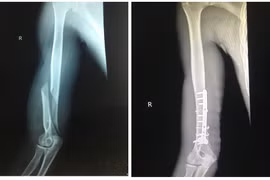 Gãy tay vì không khởi động