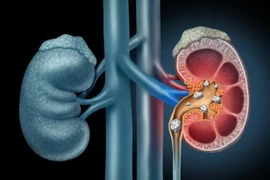 Sỏi thận và sỏi tiết niệu 