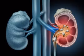 Sỏi thận và sỏi tiết niệu 