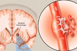 Cấp cứu đột quỵ chảy máu não do tăng huyết áp 