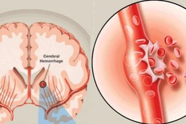 Cấp cứu đột quỵ chảy máu não do tăng huyết áp 