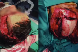 Kích hoạt báo động đỏ cứu bệnh nhân vỡ hộp sọ do kẹp thang máy