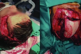 Kích hoạt báo động đỏ cứu bệnh nhân vỡ hộp sọ do kẹp thang máy