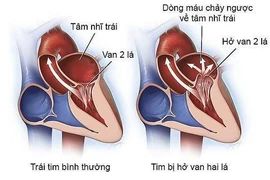 Sự khác nhau giữa hở và hẹp van hai lá