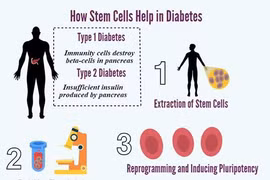Ghép tế bào gốc có điều trị khỏi đái tháo đường?