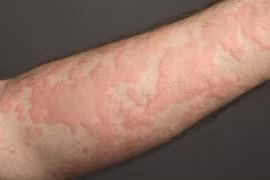 Mưa nhiều nổi mề đay