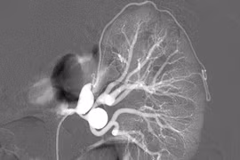 Nút mạch điều trị dị dạng động tĩnh mạch thận 