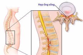 Tổn thương thần kinh do hẹp ống sống
