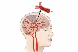 Nhồi máu não diện rộng là gì? Điều trị bằng cách nào?