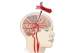 Nhồi máu não diện rộng là gì? Điều trị bằng cách nào?