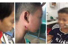 3 trẻ nhỏ xứ Nghệ bị "vi khuẩn ăn thịt người" tấn công tuyến nước bọt mang tai