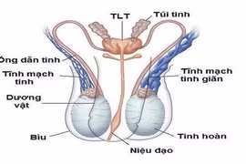 Giãn tĩnh mạch thừng tinh dễ gây vô sinh