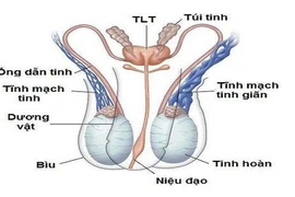 Giãn tĩnh mạch thừng tinh dễ gây vô sinh