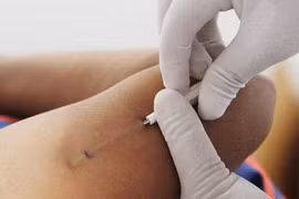 Sử dụng miếng dán và cấy que tránh thai sau sinh