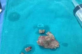 Phương pháp tán sỏi ngoài cơ thể chỉ áp dụng sỏi nhỏ