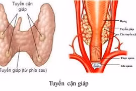 Suy tuyến cận giáp