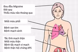 Cẩn thận với hội chứng kháng phospholipid nguy hiểm