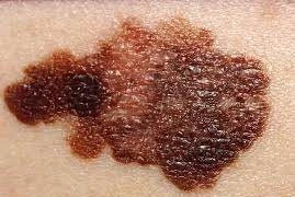 Ung thư da gia tăng, ngày càng trẻ hóa