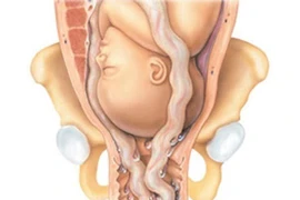 Sa dây rau - tai biến sản khoa nguy hiểm 