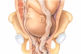 Sa dây rau - tai biến sản khoa nguy hiểm 