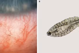 Viêm hốc mắt do ấu trùng ruồi xâm nhập 