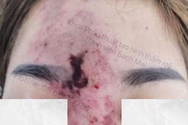 Hoại tử mũi và trán do tiêm filler