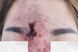 Hoại tử mũi và trán do tiêm filler