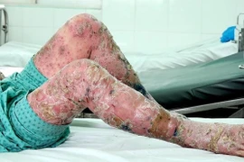 Uống thuốc tiêu độc thành nhiễm độc nặng