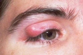 Hỏng mắt vì sát gấu quần trị chắp lẹo