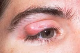 Hỏng mắt vì sát gấu quần trị chắp lẹo