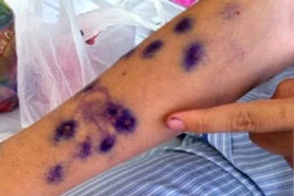 Thủy đậu người lớn chớ chủ quan