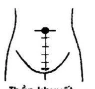 Chữa táo bón bằng xoa bóp bấm huyệt